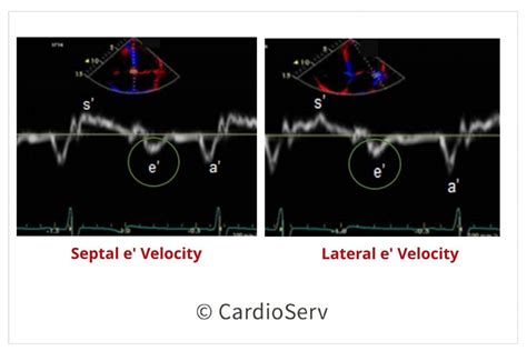 lv e' lateral velocity